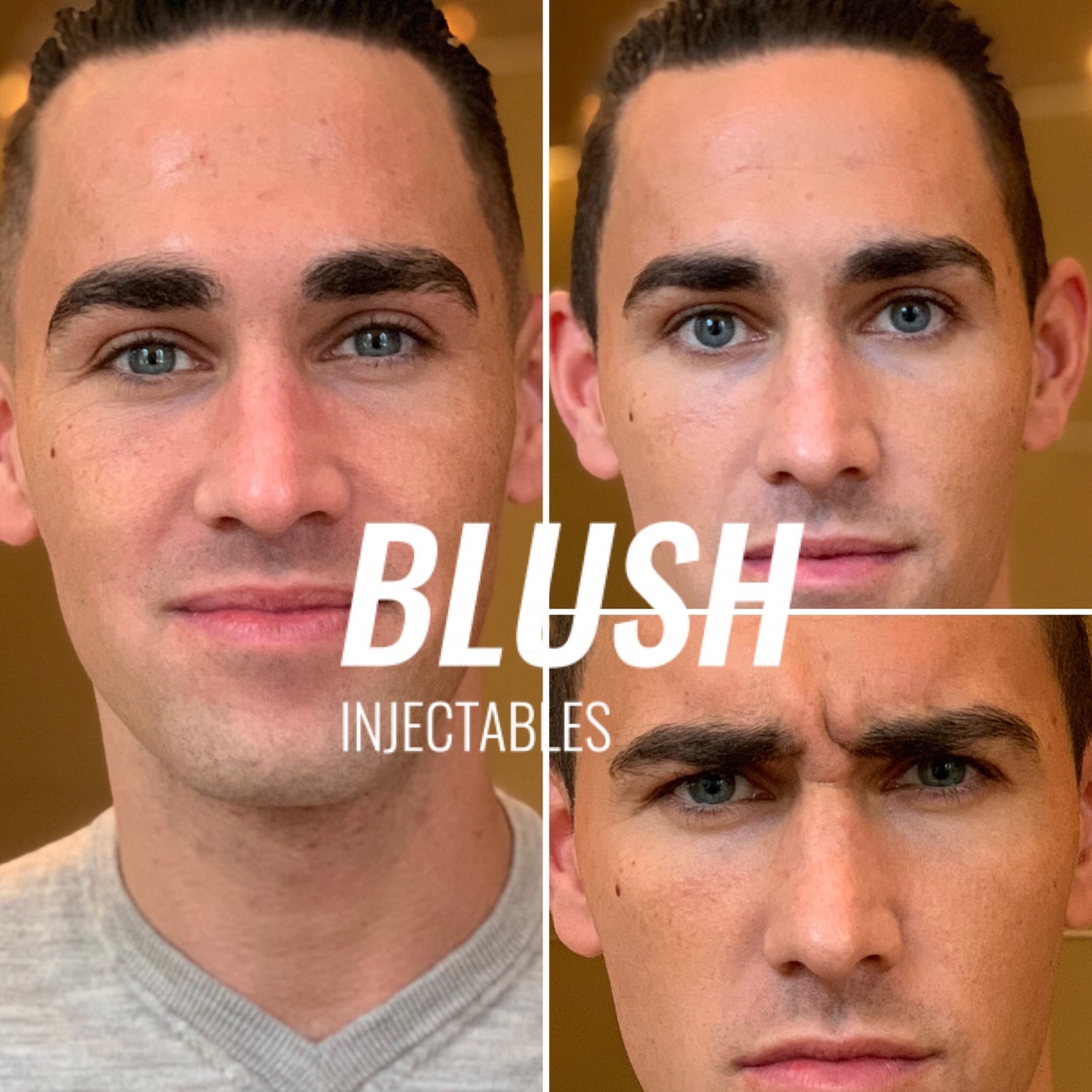 Botox treatment at Blush Injectables in Best-Eindhoven Botox treatment at Blush Injectables in Best-Eindhoven