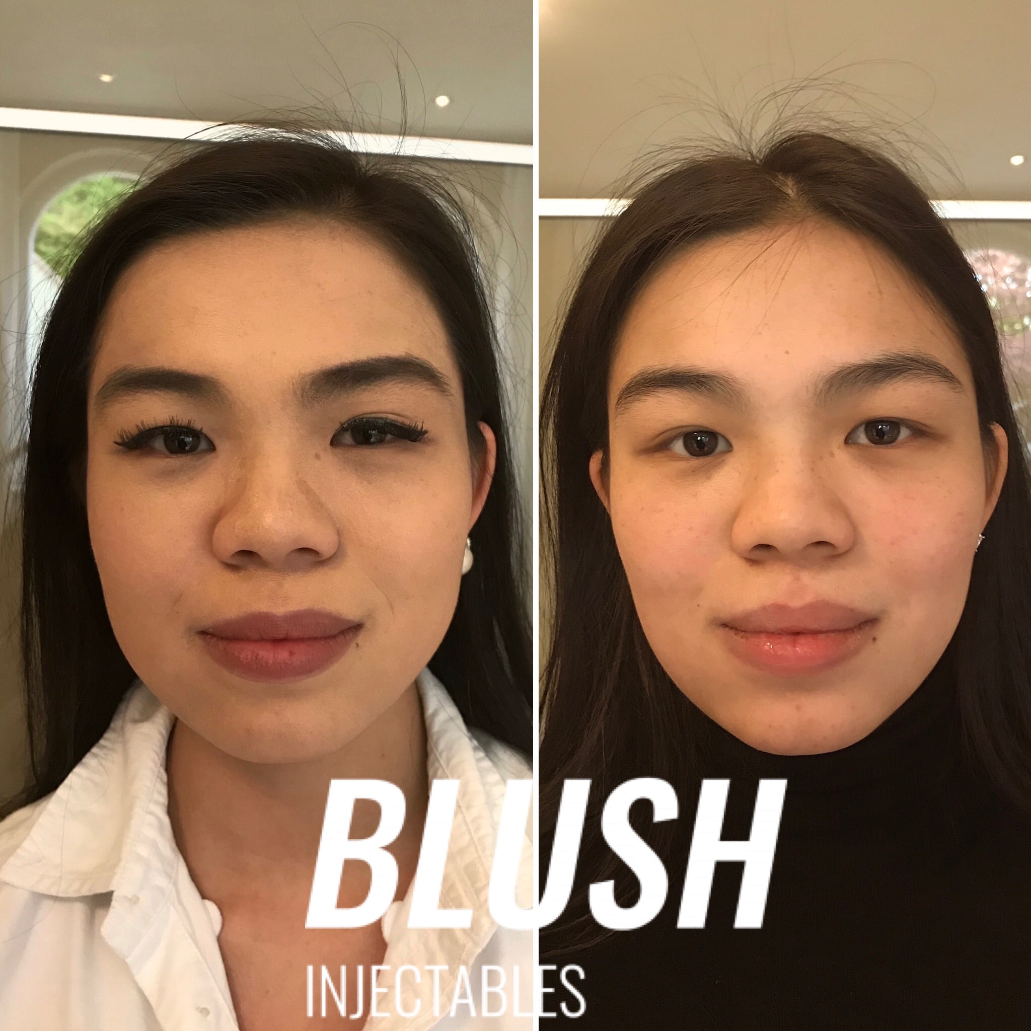faceslimming botox before and after blush injectables ... faceslimming botox before and after blush injectables ...