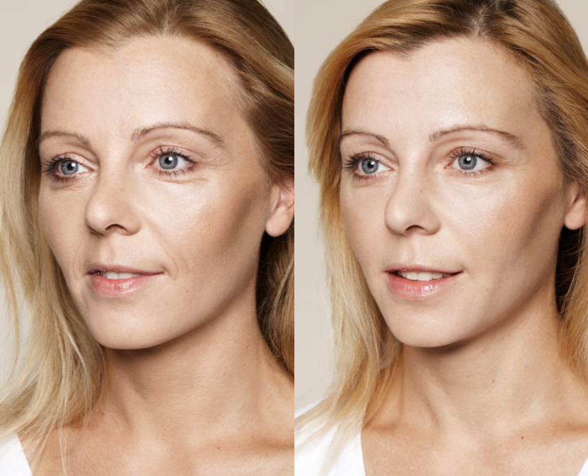 Profhilo behandeling door dokter Yulia Blush in Best bij Eindhoven