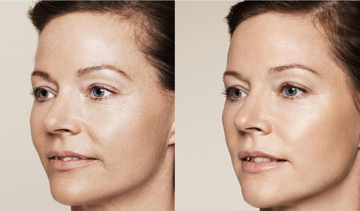 Sculptra collageen bij dokter Yulia & JeanPaul Blush Eindhoven
