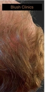 haar stimulatie blush clinics na