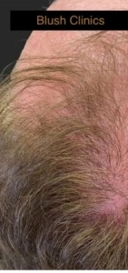 haar stimulatie blush clinics voor