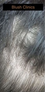 man voller haar voor
